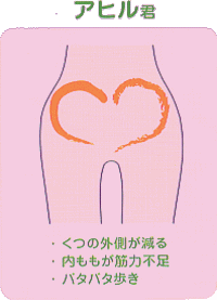 ・くつの外側が減る ・内ももが筋力不足 ・パタパタ歩き